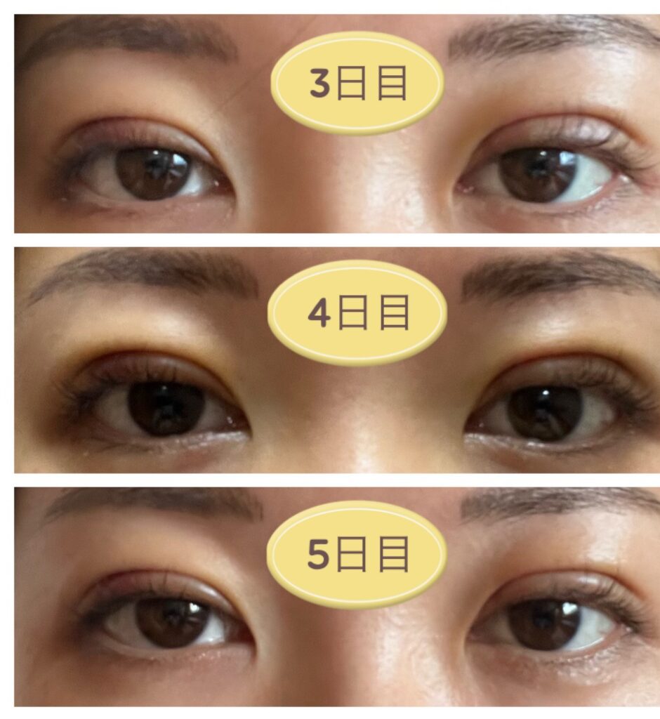 二重埋没3～5日目の写真