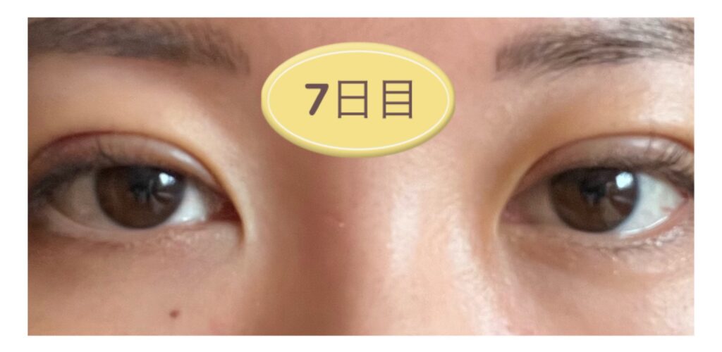 二重埋没後1週間の写真