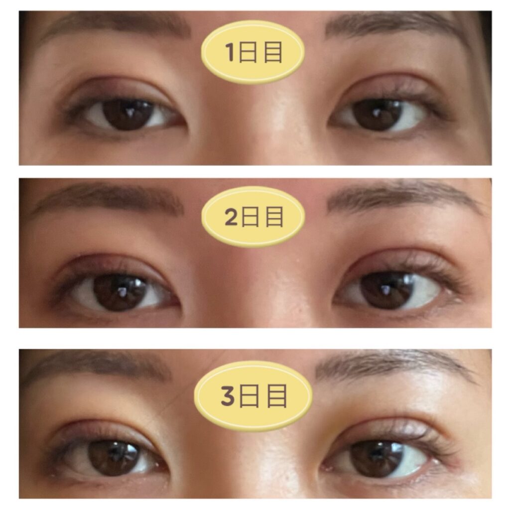二重埋没翌日～3日目の写真