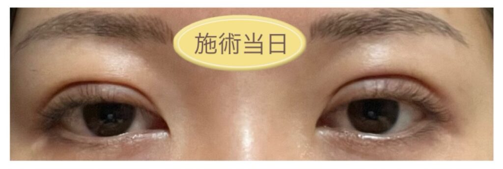 二重埋没の施術直後の写真