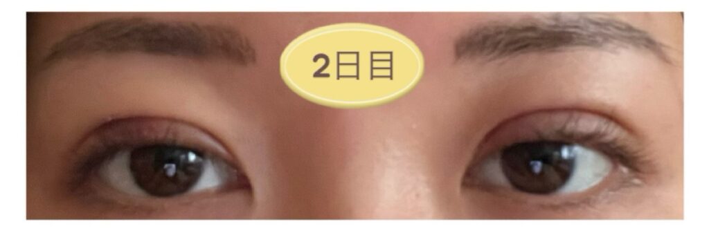 二重埋没2日目の写真