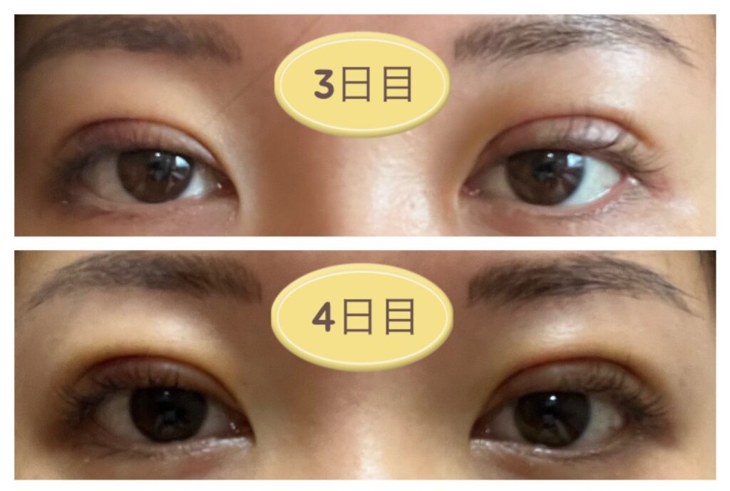 二重埋没3～4日目の写真