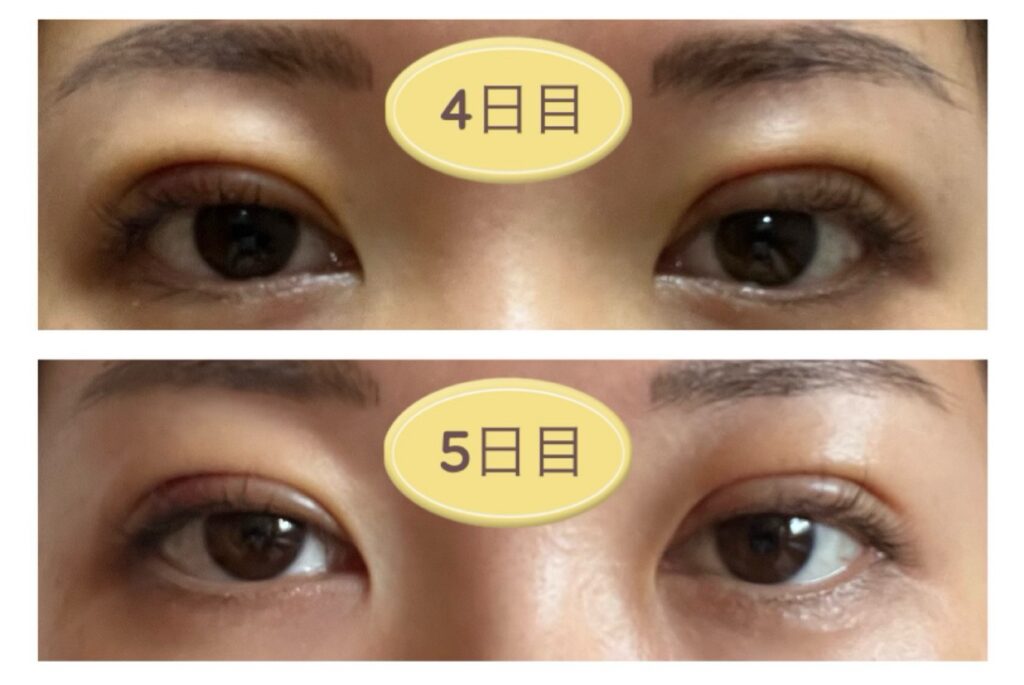 二重埋没4～5日目の写真