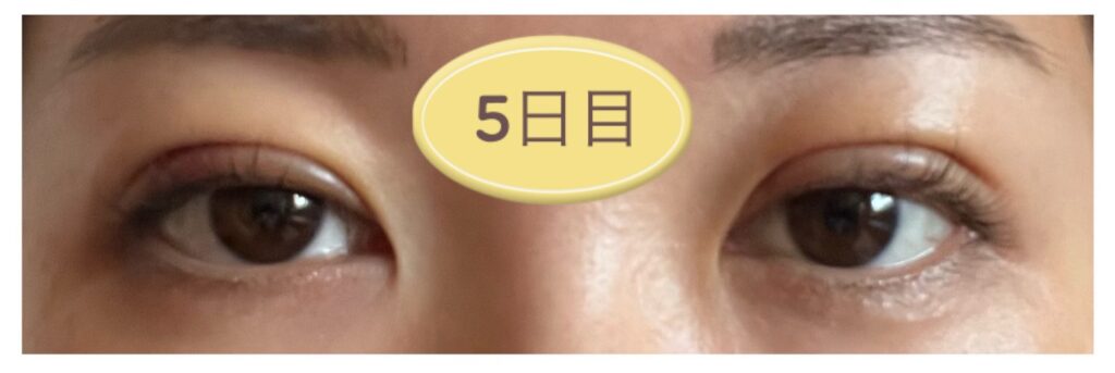 二重埋没5日目の写真