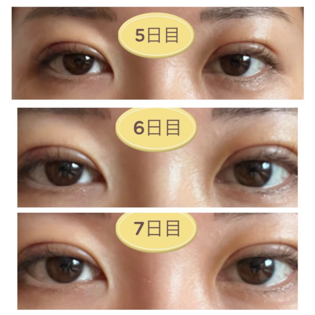 二重埋没5～7日目の写真