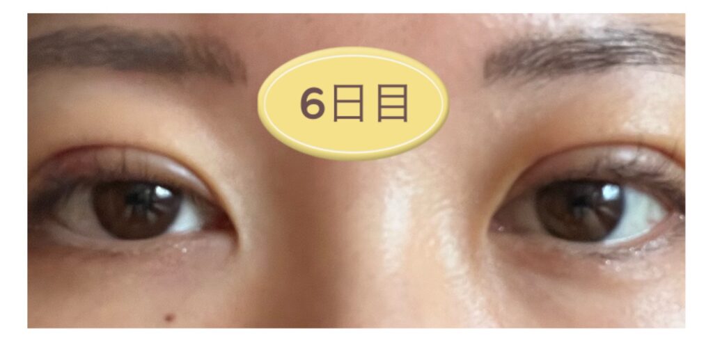 二重埋没6日目の写真