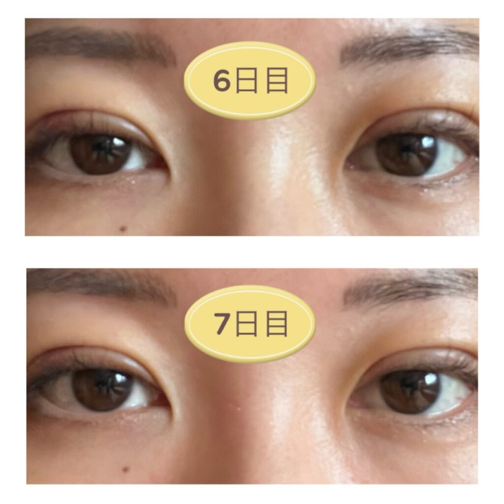 二重埋没6～7日目の写真