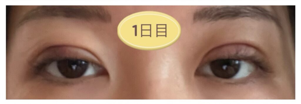 二重埋没1日後の写真