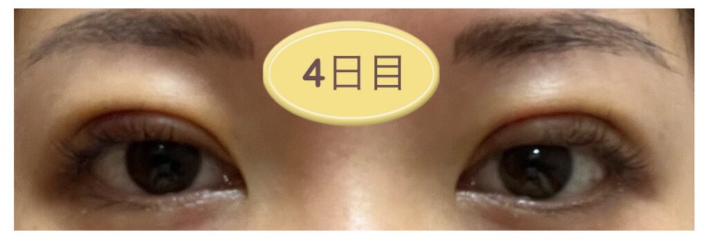 二重埋没4日目の写真