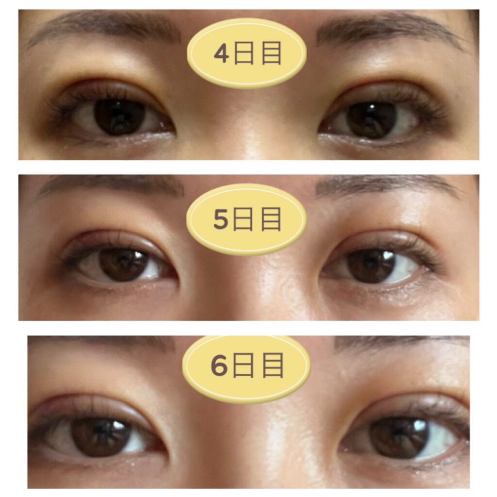 二重埋没4～6日目の写真