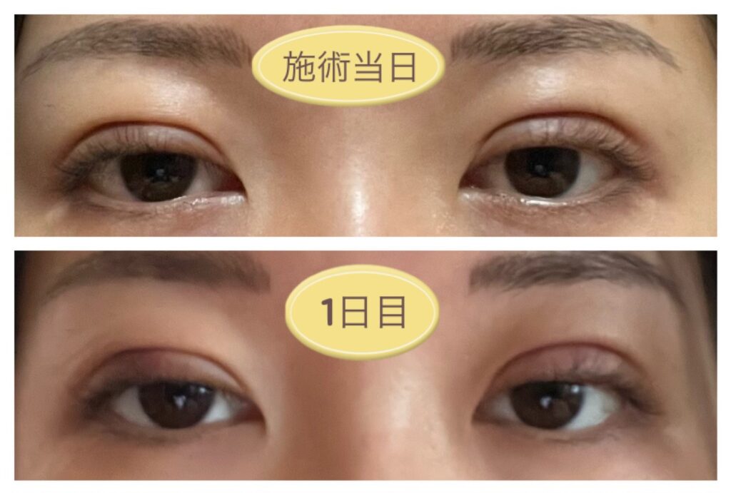 二重埋没当日～翌日の写真