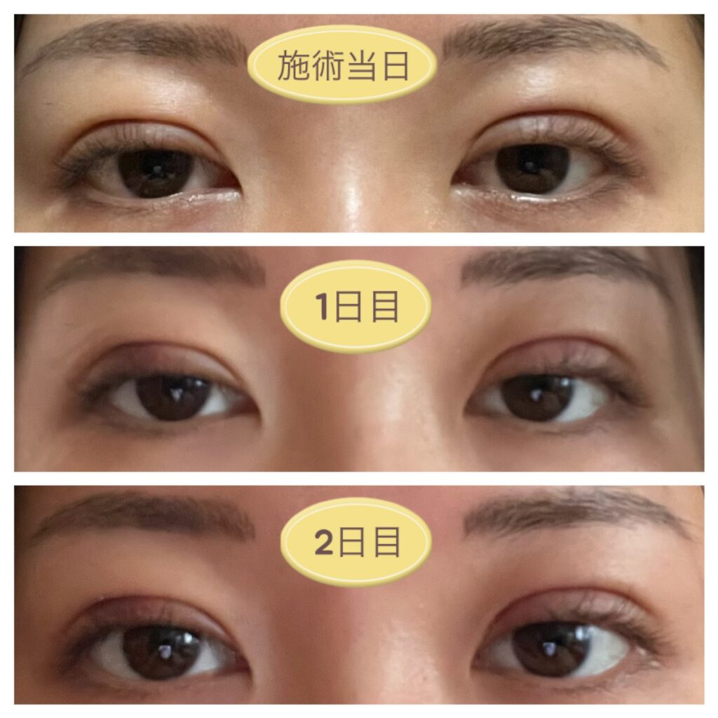 二重埋没当日～2日目の写真