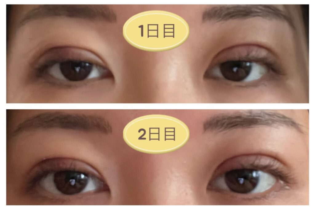 二重埋没の施術後1～2日目の写真