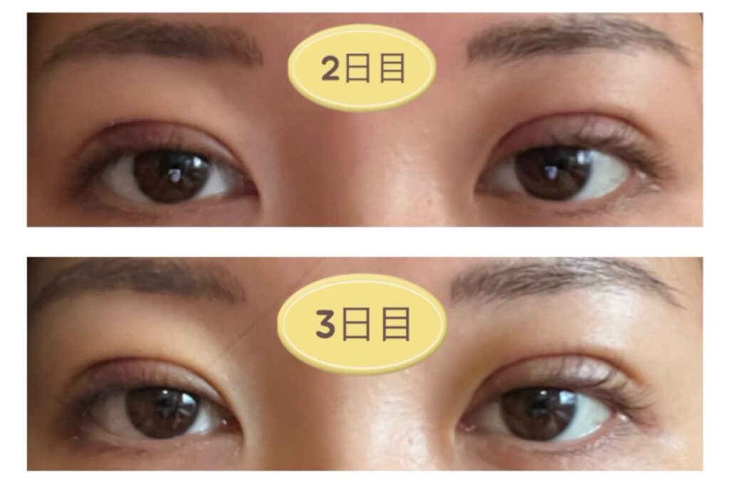 二重埋没の施術2～3日目の写真