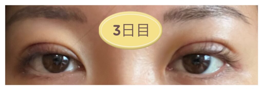 二重埋没の施術3日目の写真